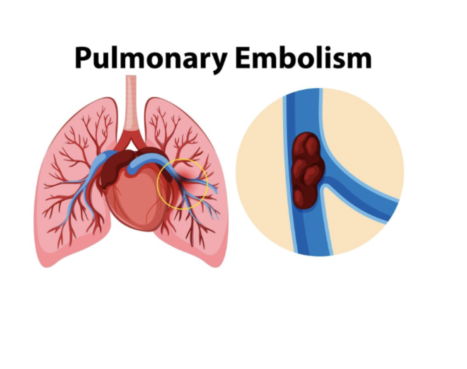 The Warning Signs of Acute Pulmonary Embolism in Holter Heart Monitor